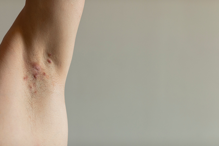 Hidradenitis supurativa: qué es y cuál es su tratamiento